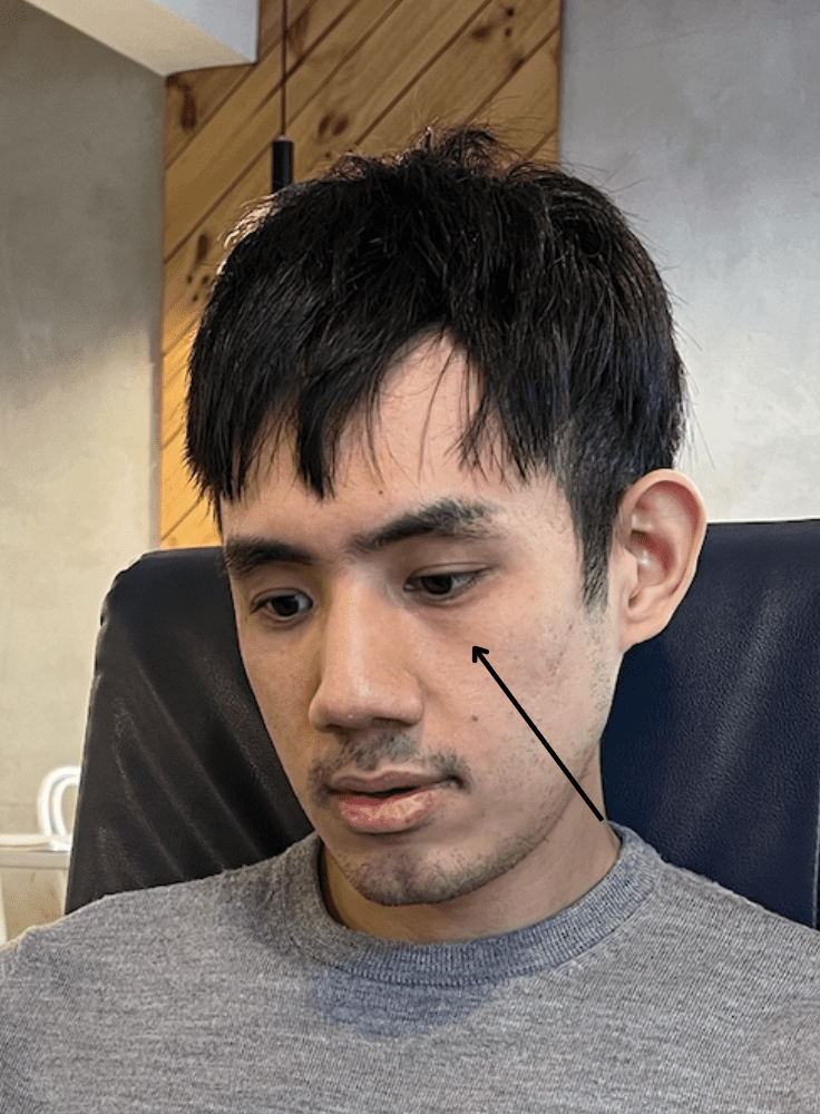 淚溝醫美