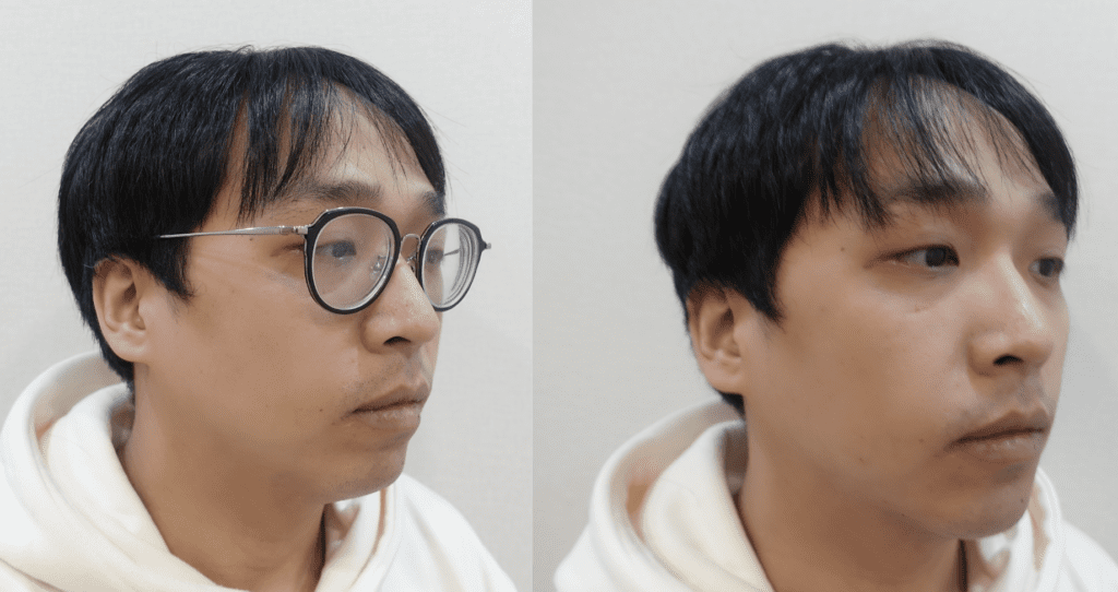 下巴玻尿酸幾cc